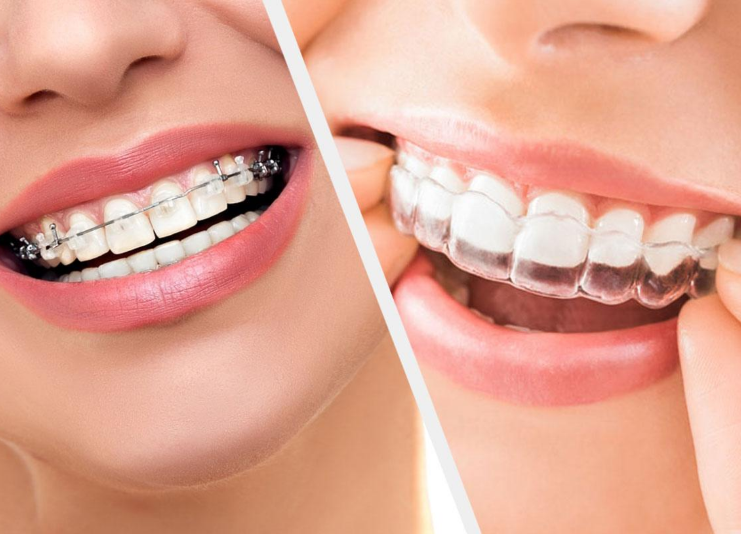 Orthodontics Treatment – Qualident Ağız Ve Diş Sağlığı Polikliniği